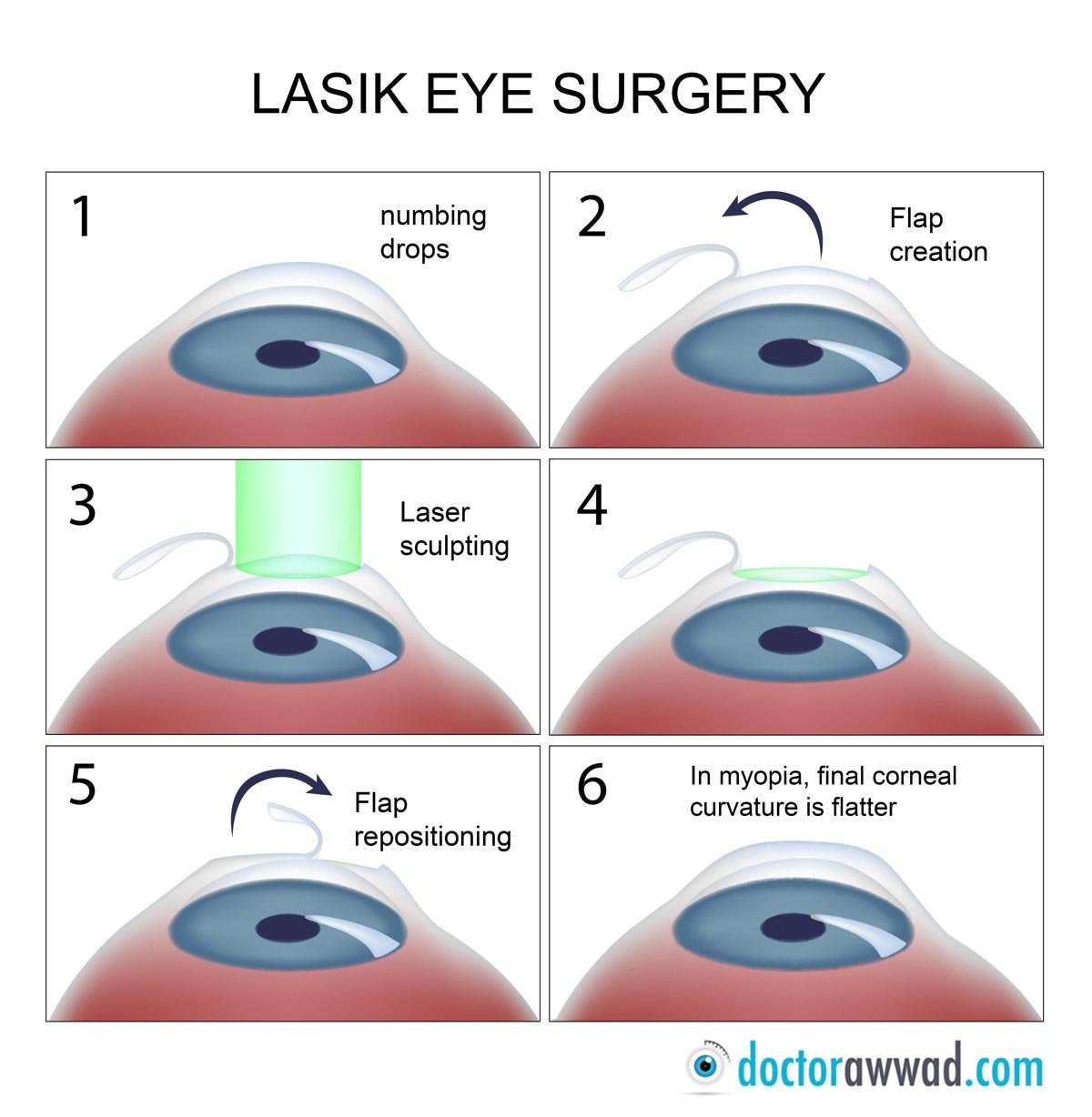 LASIK femtoLASIK IntraLASIK Dr Shady Awwad Eye Surgeon At AUBMC