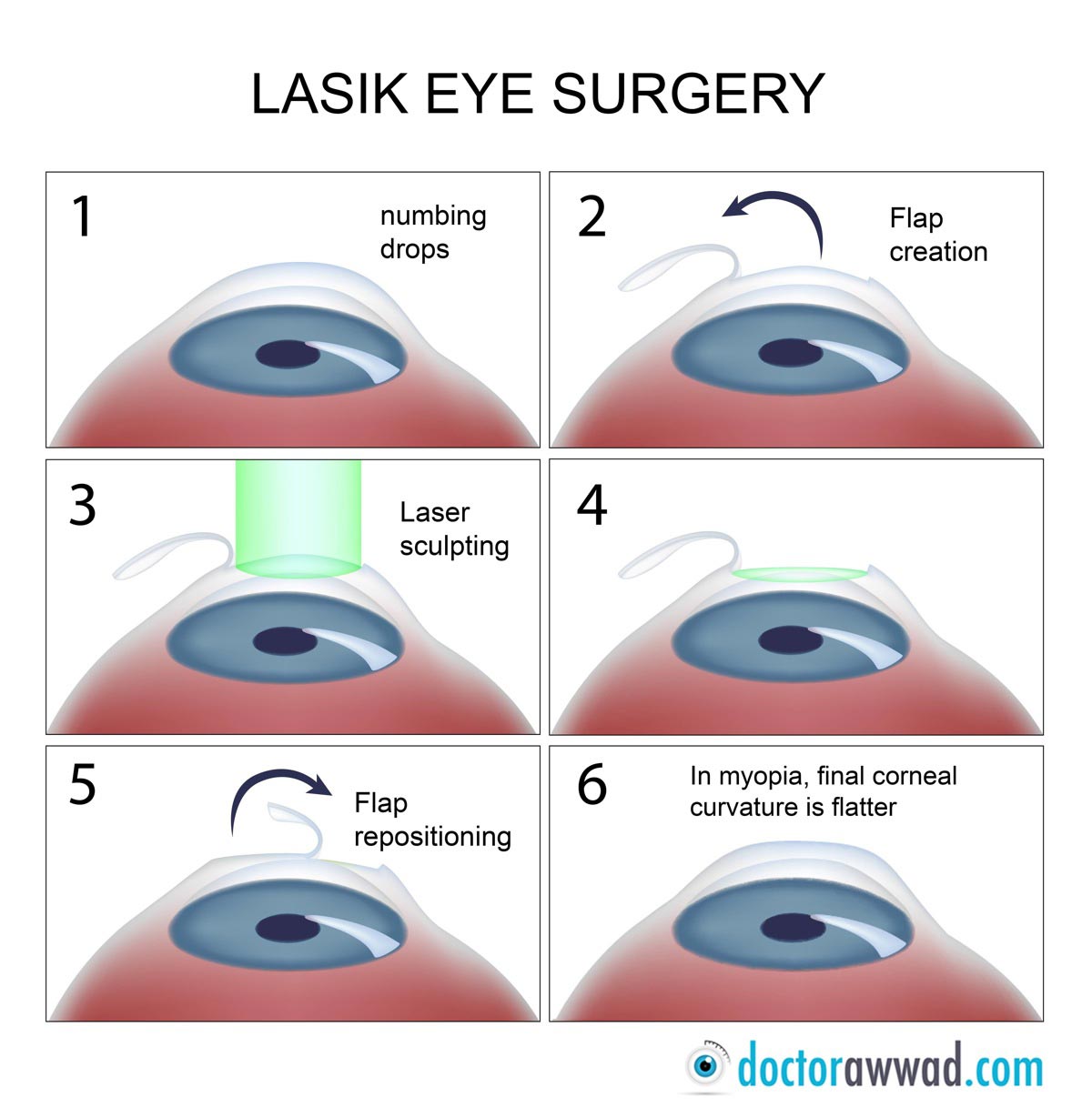 What is LASIK, what's PRK? | Dr Shady Awwad, eye surgeon ...