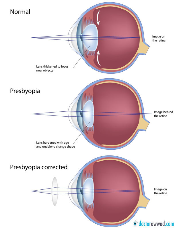 presbyopia jelentése magyarul